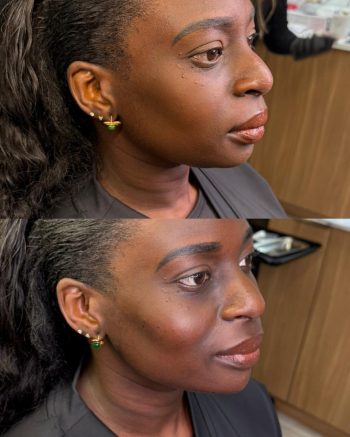 Facial Balancing