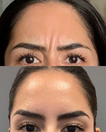 Botox