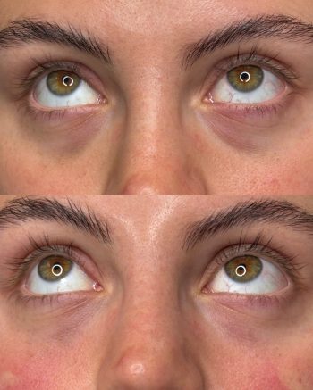Under-Eye Filler