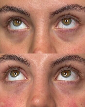 Under-Eye Filler