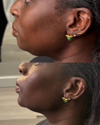 Chin Filler