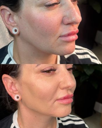 Facial Contouring