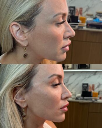 Facial Contouring