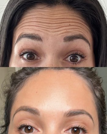 Botox