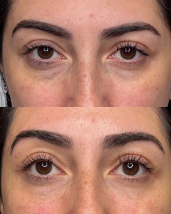 Under-Eye Filler