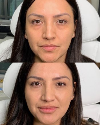 Facial Contouring
